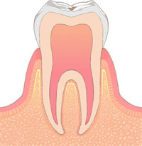 虫歯の症状と治療