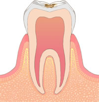虫歯の症状と治療