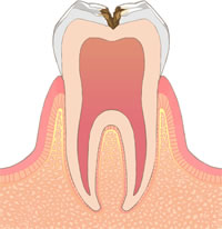 虫歯の症状と治療