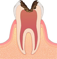 虫歯の症状と治療