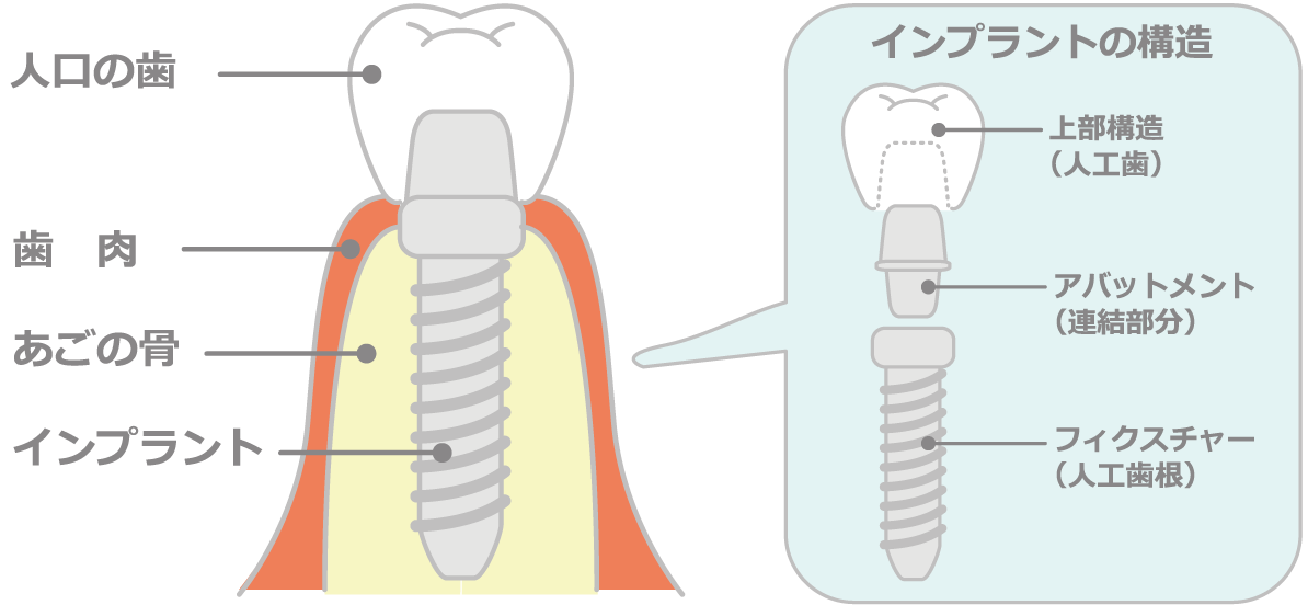 インプラントとは