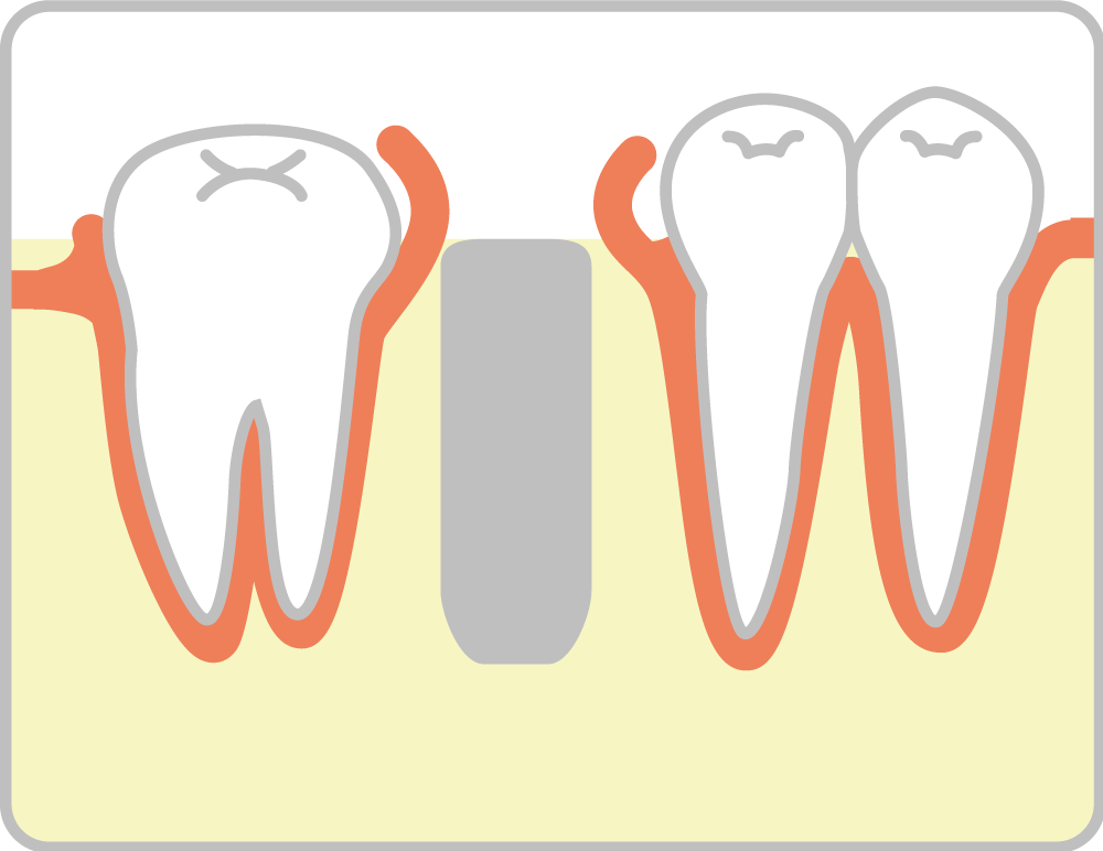 インプラント治療の流れ