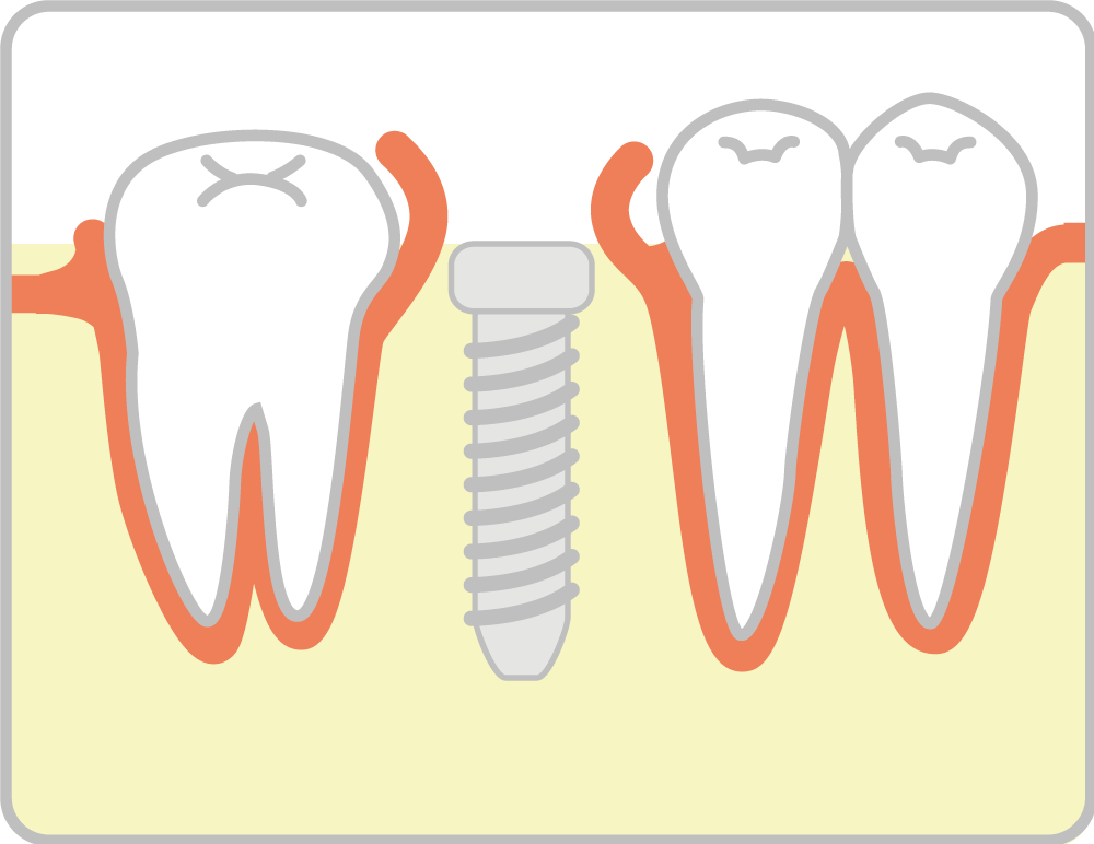 インプラント治療の流れ