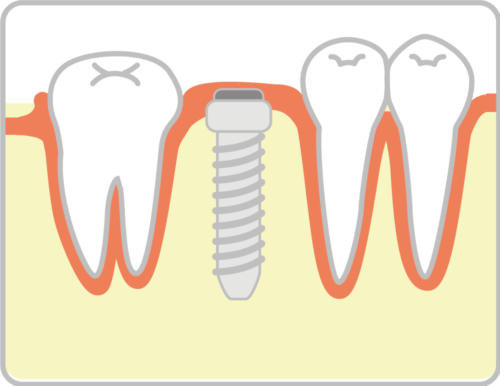 インプラント治療の流れ