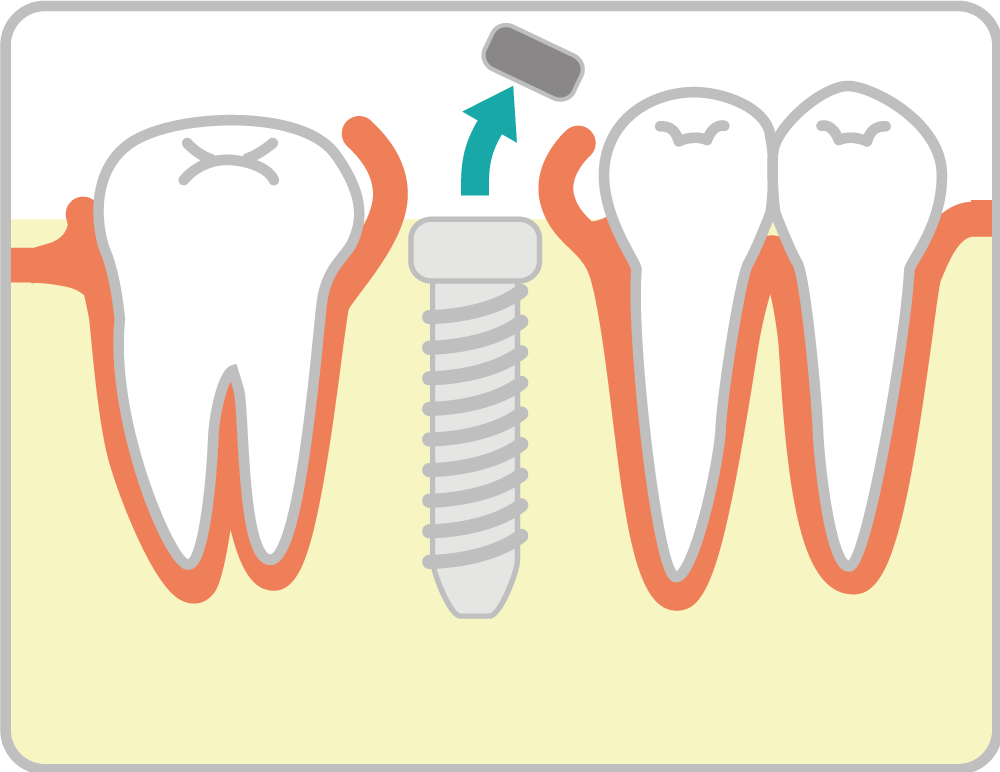インプラント治療の流れ