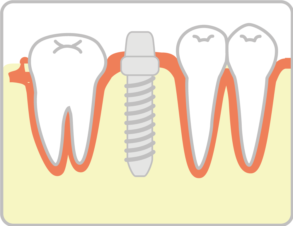 インプラント治療の流れ