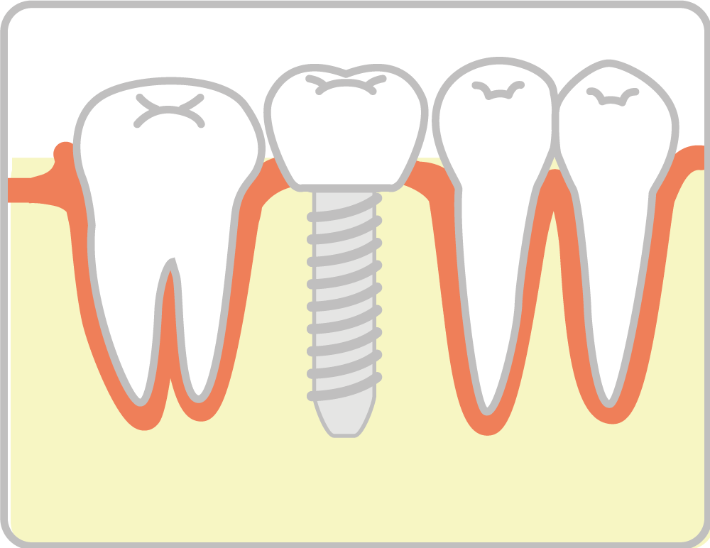 インプラント治療の流れ