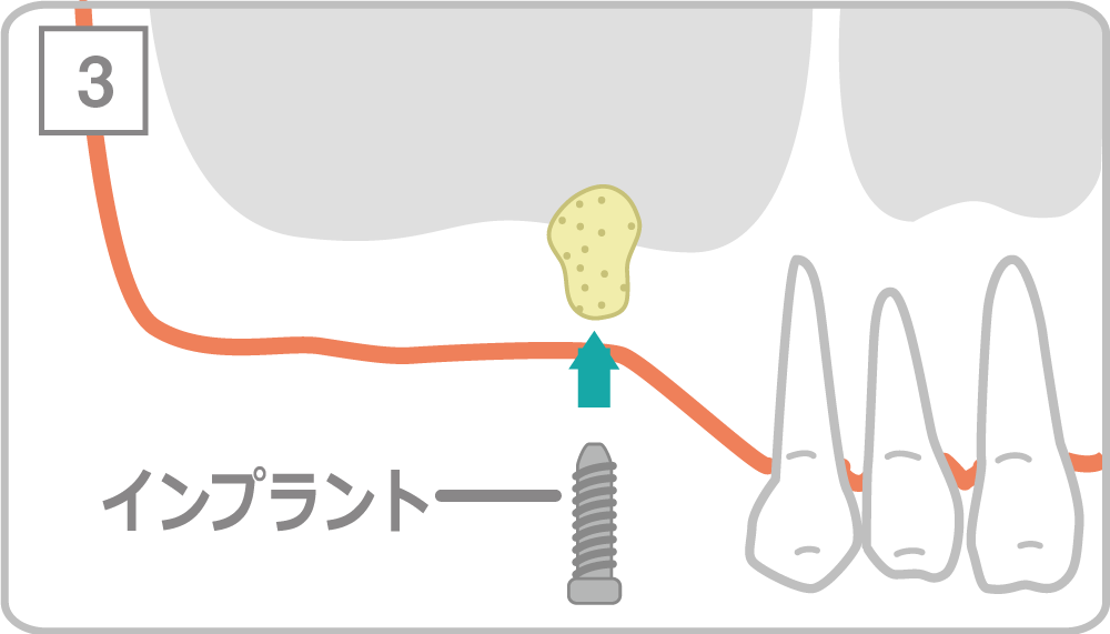 ソケットリフト