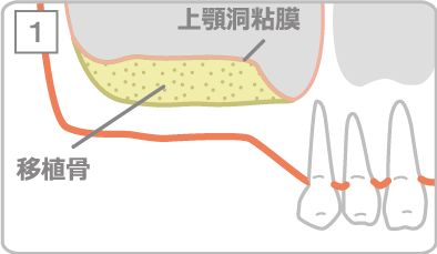 サイナスリフト