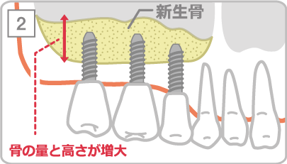 サイナスリフト